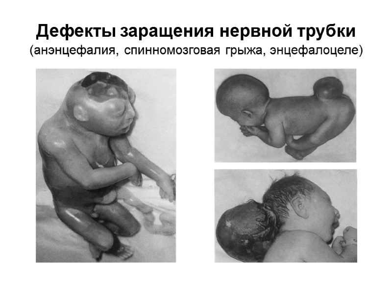 Дефекты заращения нервной трубки (анэнцефалия, спинномозговая грыжа, энцефалоцеле)